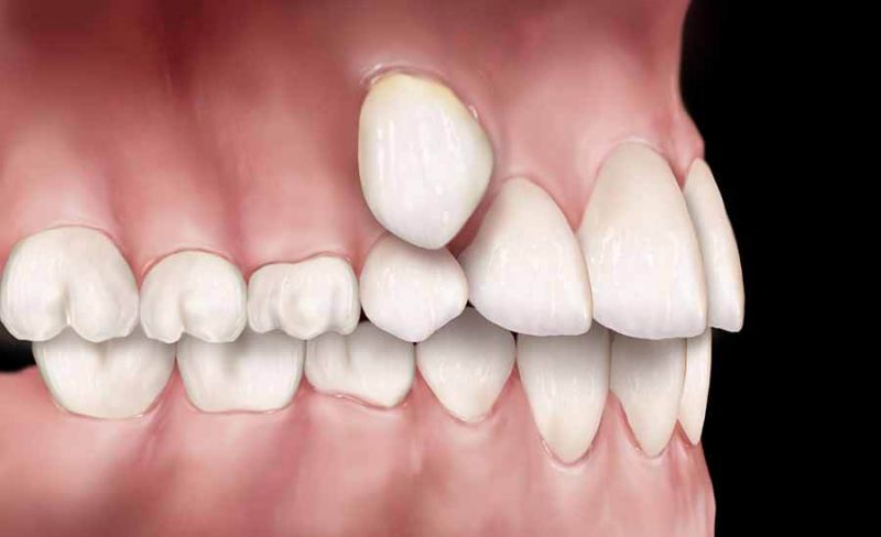 Дистопированные зубы фото 1