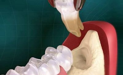 Entfernung von kariösen Zähnen фото 1