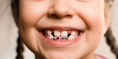 Детская ортодонтия фото 1