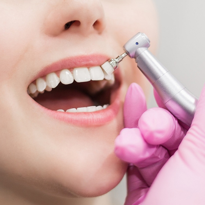 Professionelle Zahnreinigung in Barcelona: Optimale Zahnhygiene erreichen