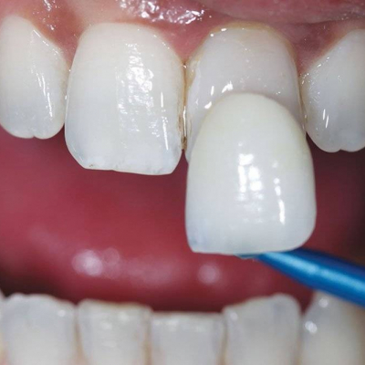 Restauración dental en la clínica Corona Dental de Barcelona