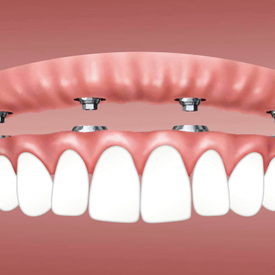 Prótesis Dentales: Una Variedad de Métodos y Materiales