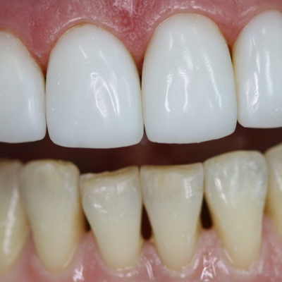 Restauración estética de los dientes