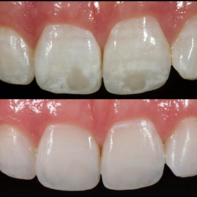 Damage to the enamel of teeth.