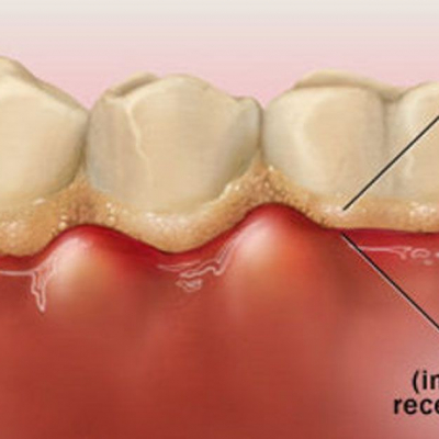 How to deal with gingivitis?