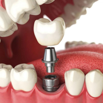 The most popular questions about dental implantation