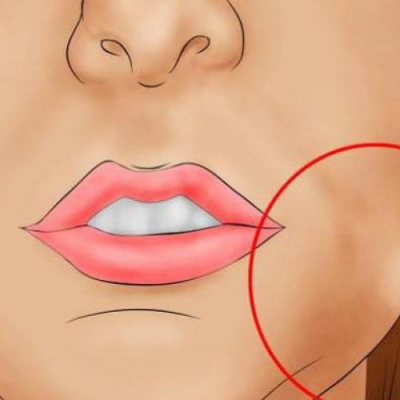 How to remove facial swelling after implantation?