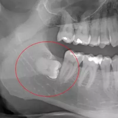 Removal of uncut wisdom teeth