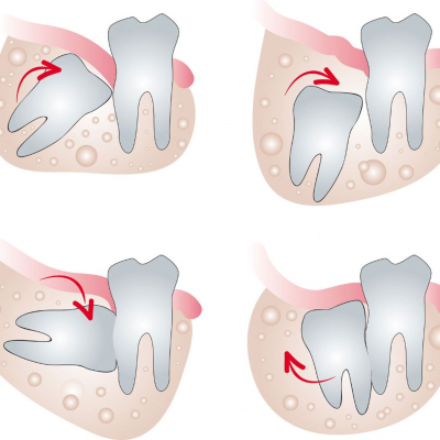 Wisdom tooth: should I remove it or leave it?