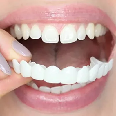 TOP 6 Fragen zu Veneers: Alles, was Sie wissen wollten