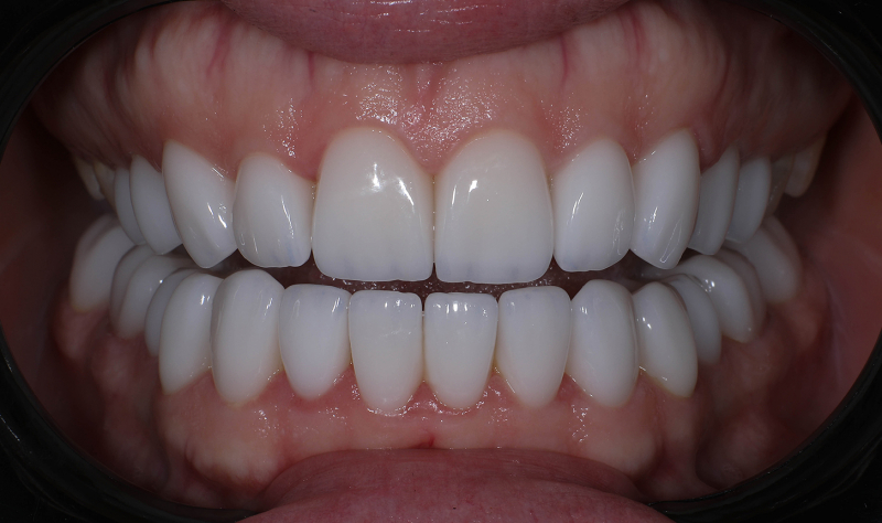 Facettes en céramique фото 1