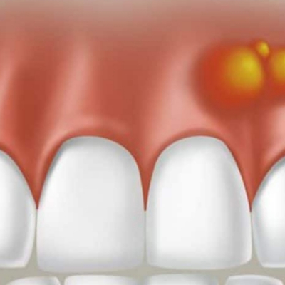 Ropień zęba: objawy, leczenie doraźne i profilaktyka w Barcelonie