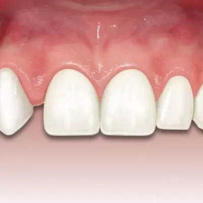 Адентия: причины, виды и современные методы лечения в Барселоне