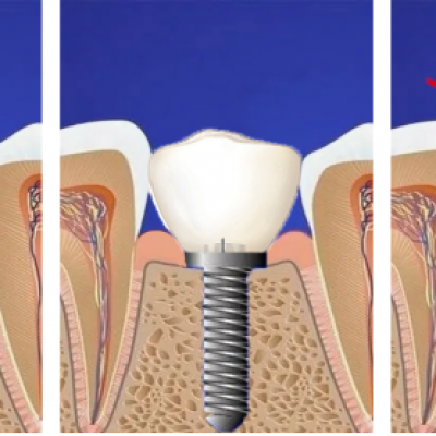 Etapy Implantacji Natychmiastowej