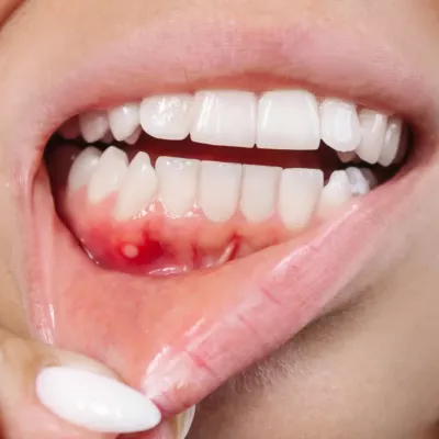 Гингивостоматит – диагностика и лечение в условиях Барселоны