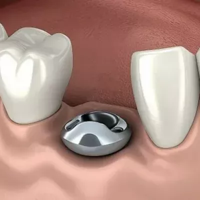 Формирователь десны на имплант: что это, зачем нужен и как ставят?