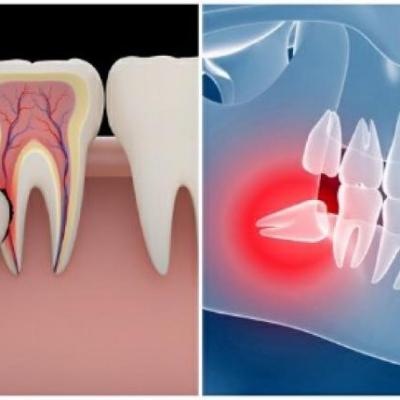 Wisdom teeth: when to remove, when to leave, and how to recover properly
