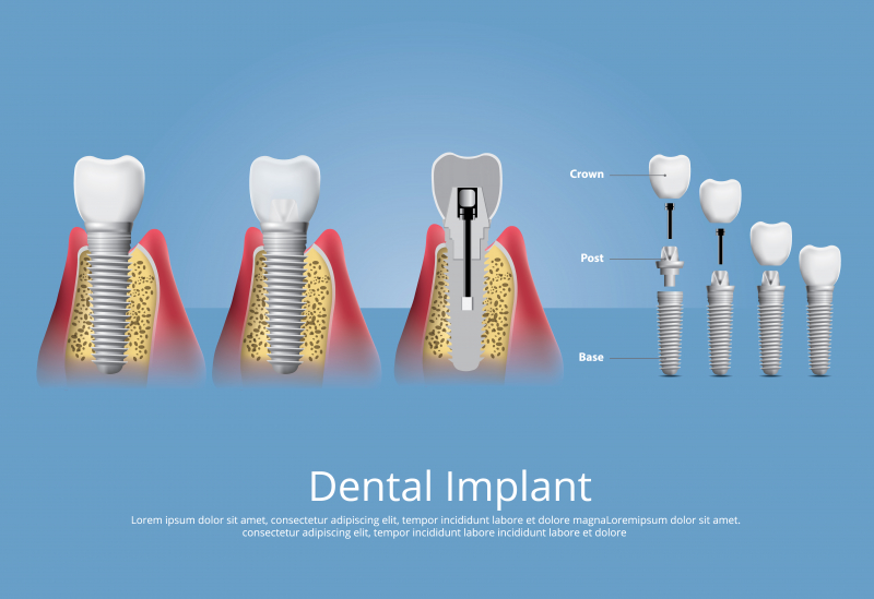 Implantes Dentales фото 2