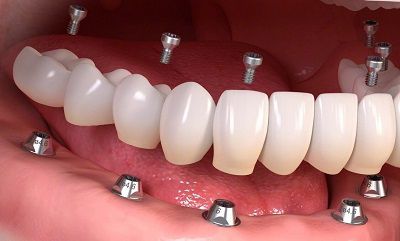 Implant Supported Overdenture фото 1