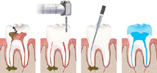 Лечение кисты зуба фото 1