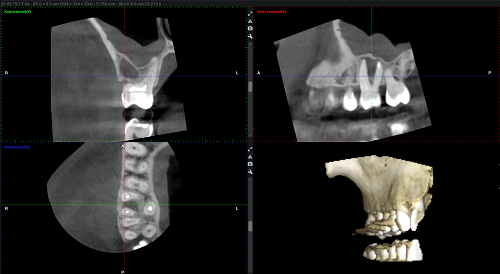 Single tooth computed tomography фото 1